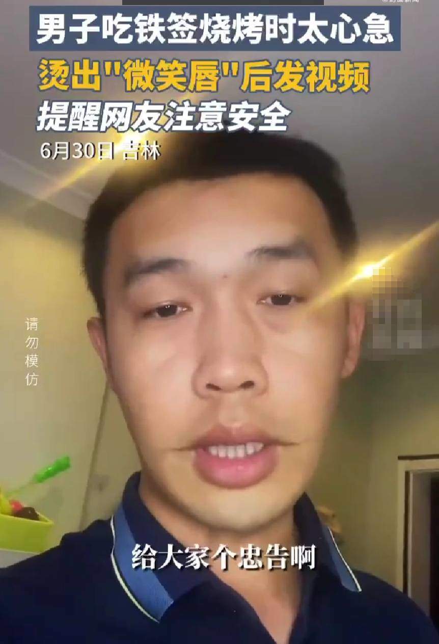 男子吃烧烤被烫出微笑唇，网友：对不起我知道很惨但真的很好笑  第1张